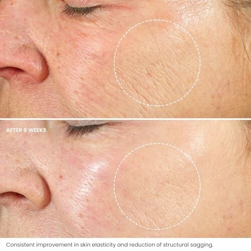 Comparison of facial skin before and after treatment showing improved elasticity and reduced sagging.